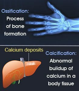 Perbedaan Osifikasi dan kalsifikasi