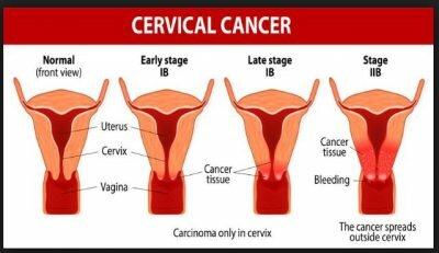 Penyebab dan Gejala Kanker Serviks